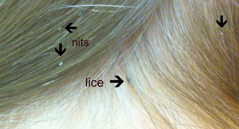 Removing Lice Naturally