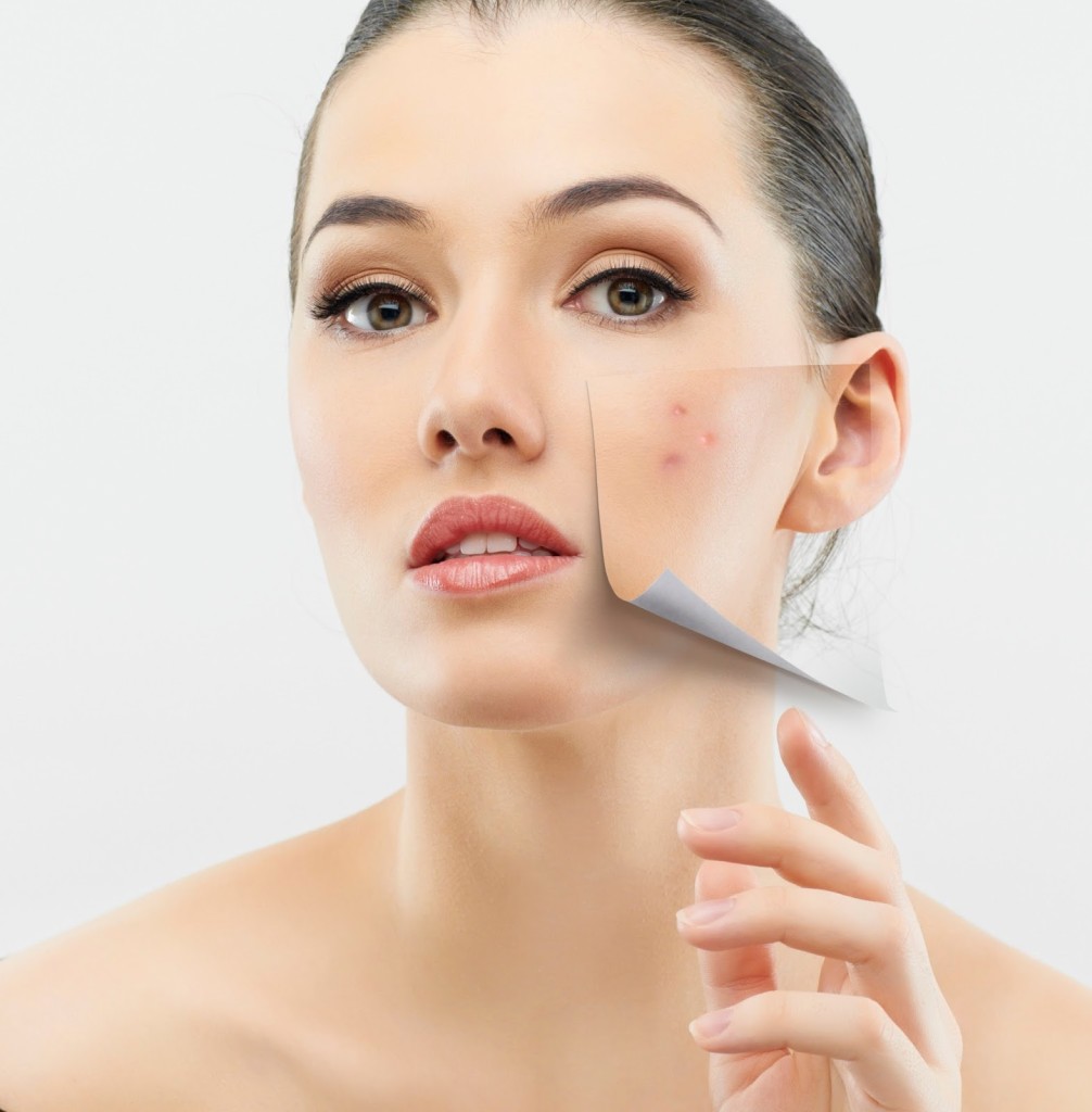Natural-Treatments-For-Acne