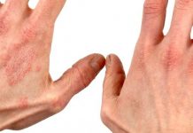 Beating Skin Allergies with These Home Remedies. No. 5 is Shocking!